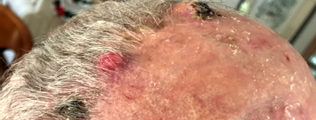 desmoplastic scalp melanomas